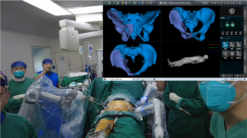 羅森博特| 智能化手術(shù)機器人成功治療92歲高齡骨盆骨折患者